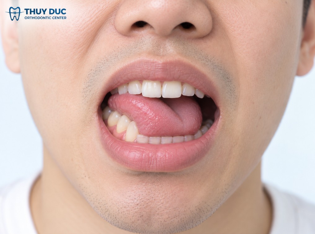 Lưỡi đẩy sang hai bên 1