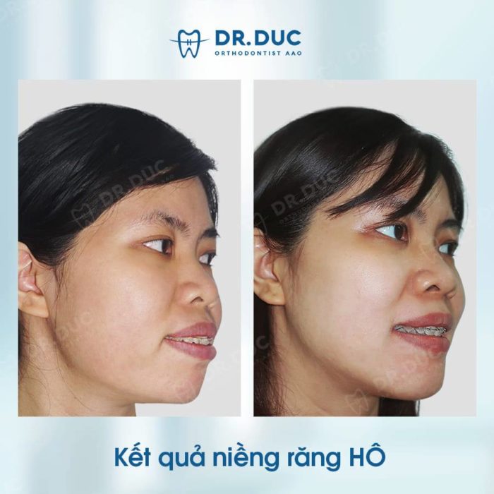 What is the procedure for niềng răng hô and how does it work?