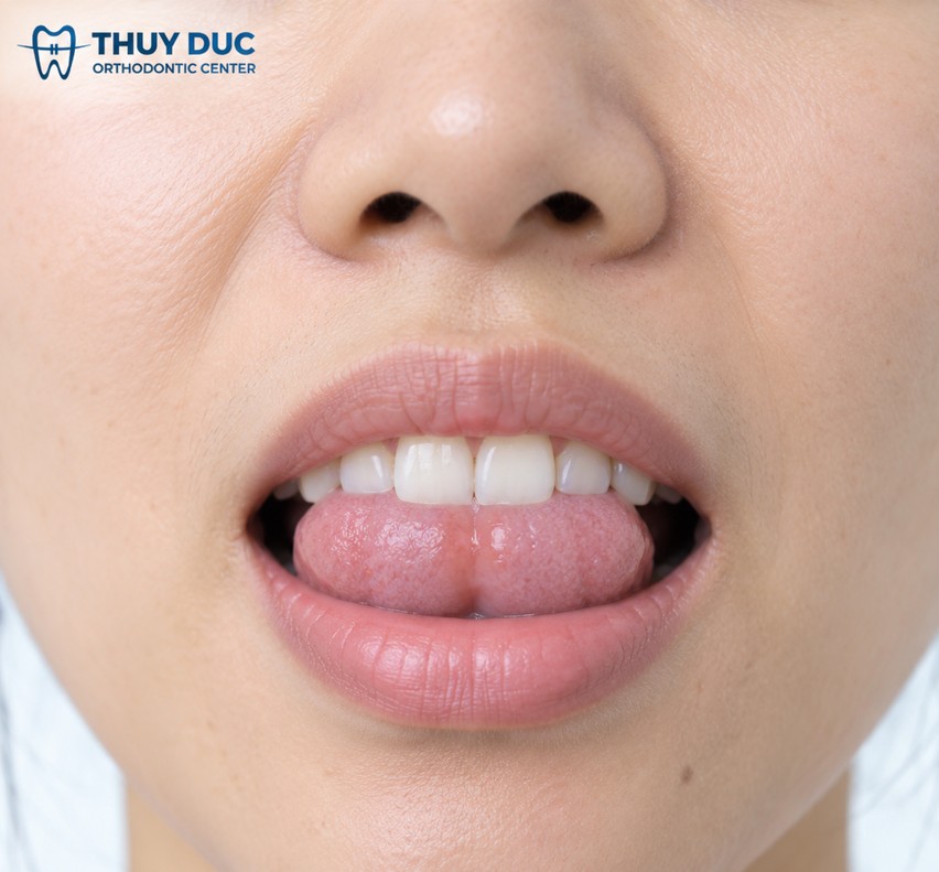 Đặt lưỡi sai vị trí có thể gây ra những vấn đề gì? 1