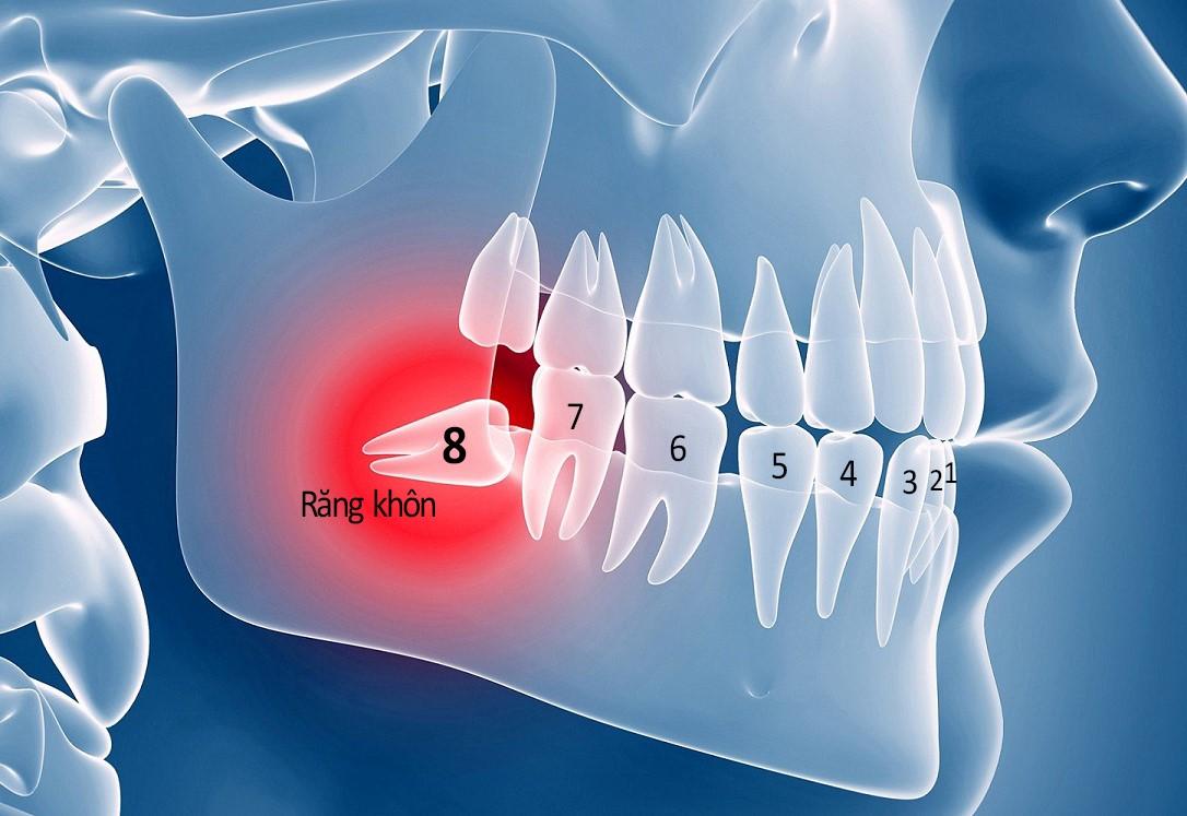 Nhổ răng khôn có nguy hiểm không? Giải đáp chi tiết