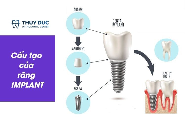 Công nghệ cấy ghép implant là gì? 1