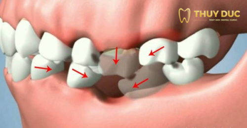 Nguyên nhân nào gây mất răng hàm? 1