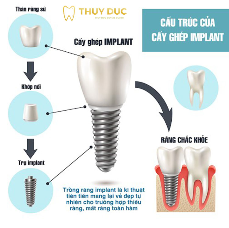 Răng implant có cấu tạo như thế nào? 1