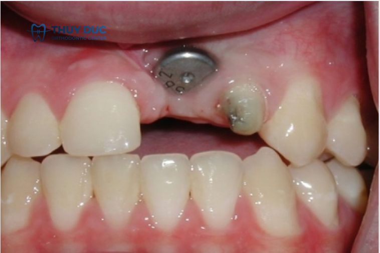 Những nguyên nhân khiến implant bị đào thải 1