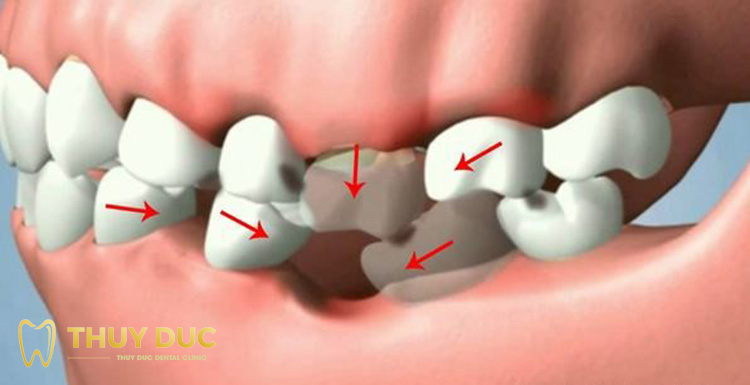 Mô hình hàm răng cho trẻ mầm non