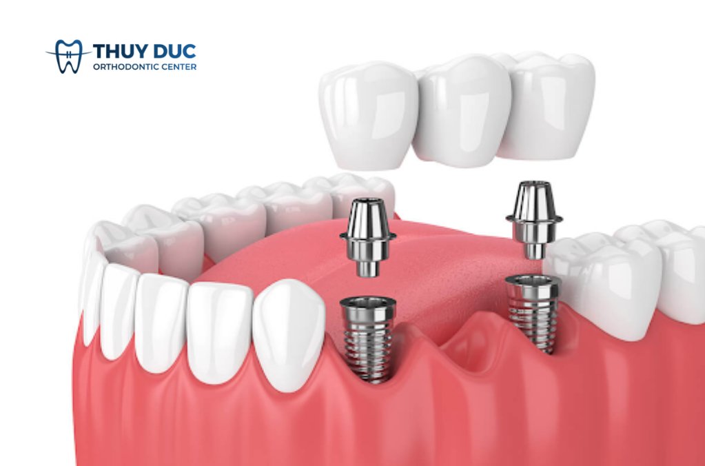 Trụ implant là gì? 1