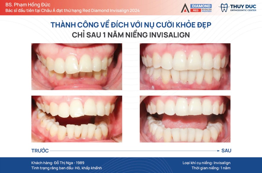 Quy trình niềng răng trong suốt Invisalign tại nha khoa Thúy Đức 1