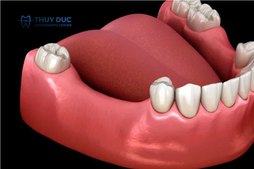 Mất 4 răng liên tiếp nhau thì trồng răng giả loại nào? 1