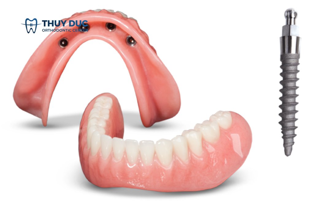 Mini implant là gì? Có nên sử dụng Mini implant không? 1