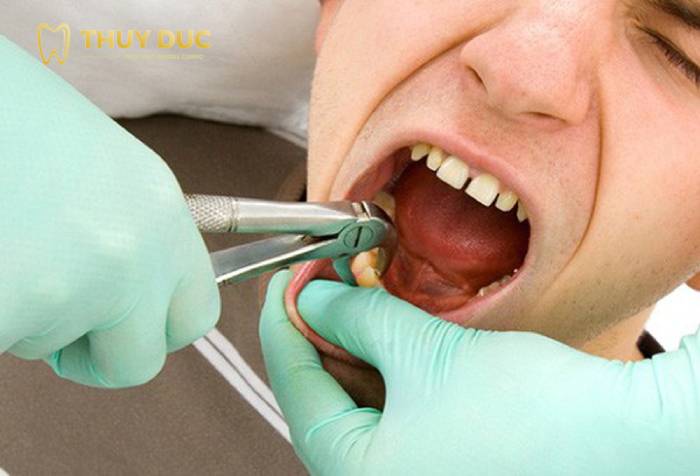 Có nên điều trị răng số 8 bị sâu hay chỉ nên nhổ luôn?
