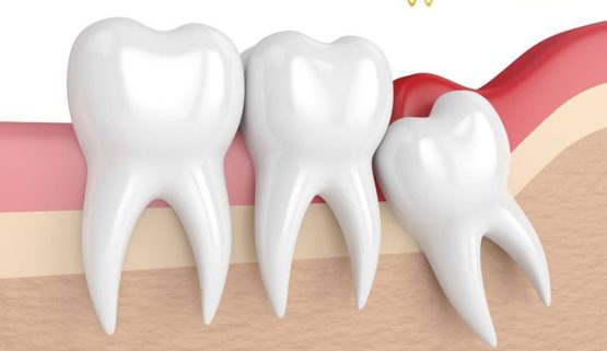 Cắt lợi trùm răng khôn bao nhiêu tiền? - Nha Khoa Thúy Đức