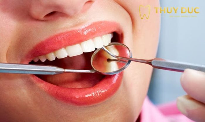3. Răng khôn đang đau có nên nhổ không? 1