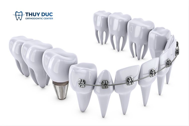 Nên niềng răng trước hay trồng răng implant trước? 1