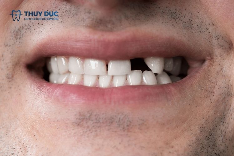 Mất răng không trồng răng giả có ảnh hưởng gì không? 1