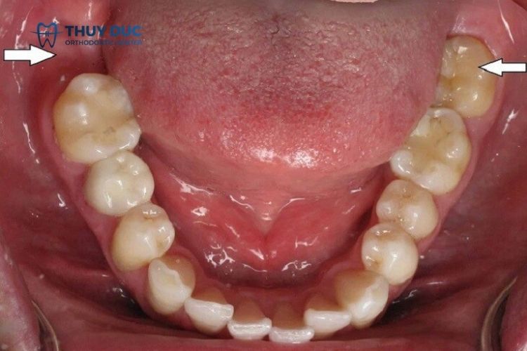 Răng số 7 là răng nào? 1