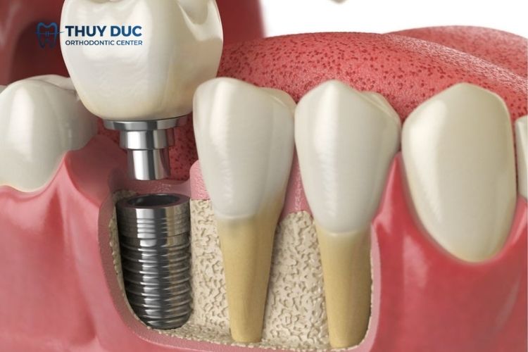 Mất răng hàm lâu năm có thể cấy ghép implant không? 1
