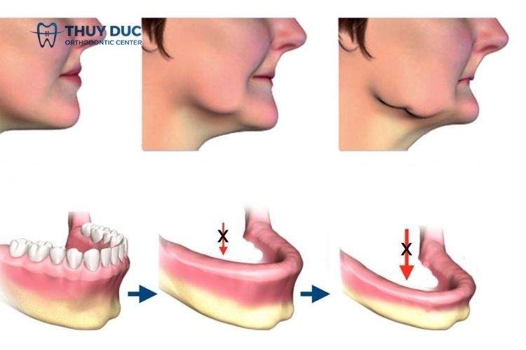 Gây tiêu xương hàm, lão hóa sớm 1