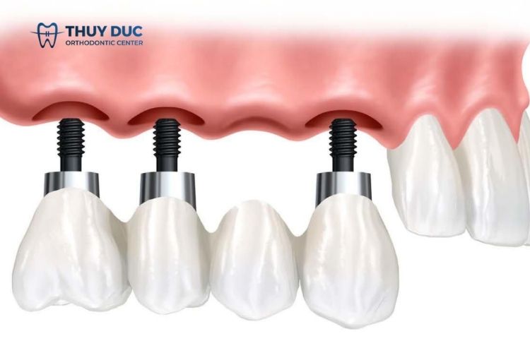 Bước 4: Lấy dấu răng để chế tác răng sứ 1