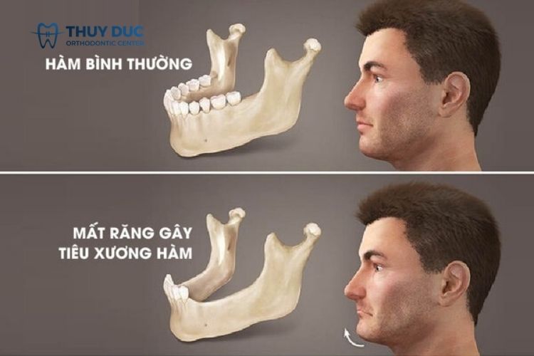 Nguy hại khi mất răng ở độ tuổi trưởng thành 1