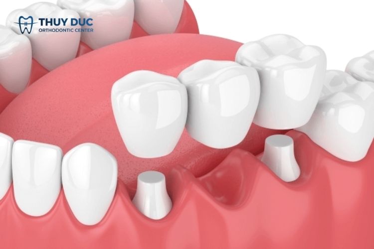 Trồng răng bắc cầu là gì? Có nên không? 1
