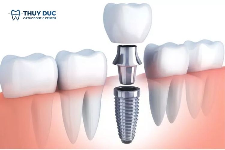 Trồng răng giả có ảnh hưởng gì tới sức khỏe không? 1