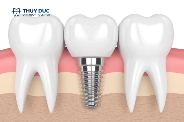 Quy trình cấy ghép implant vô trùng 1