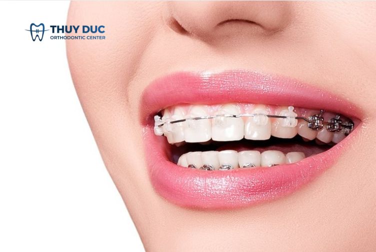 Niềng răng là gì? 1
