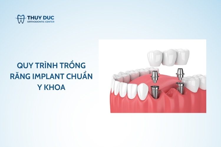 Quy trình trồng răng implant chuẩn Y khoa