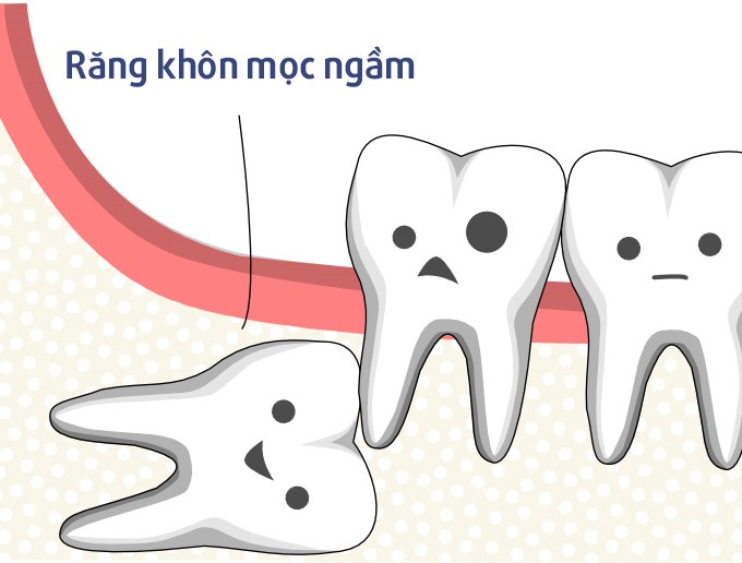 Răng khôn mọc ngầm là thế nào? 1