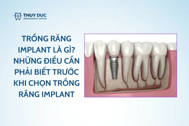 Trồng răng implant là gì? Những điều cần phải biết trước khi chọn trồng răng implant