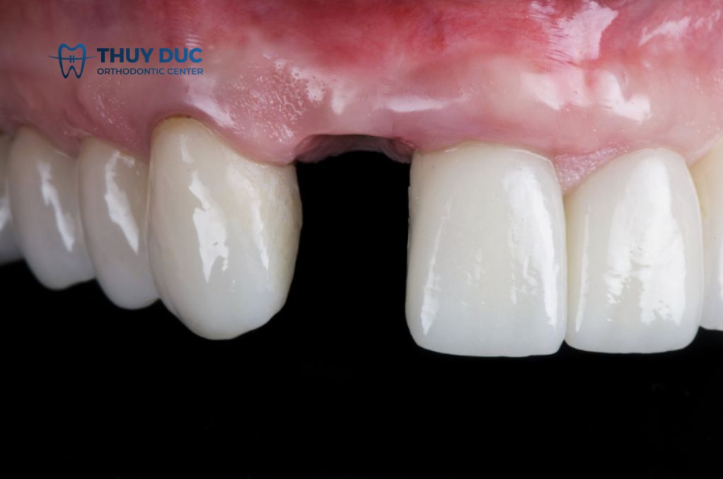 1. Mất răng lâu năm gây ra hậu quả gì? 1