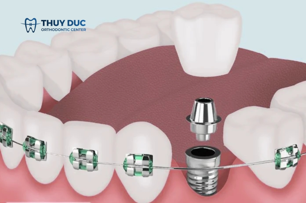 [Tư vấn] Trồng răng implant có niềng răng được không? 1