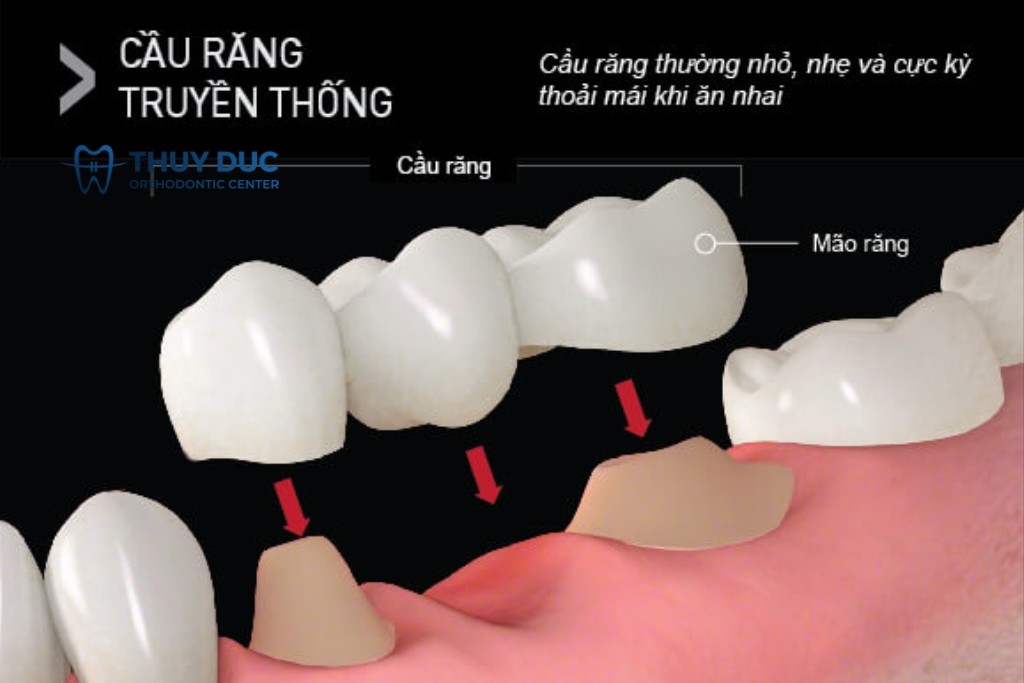 Cầu răng truyền thống 1