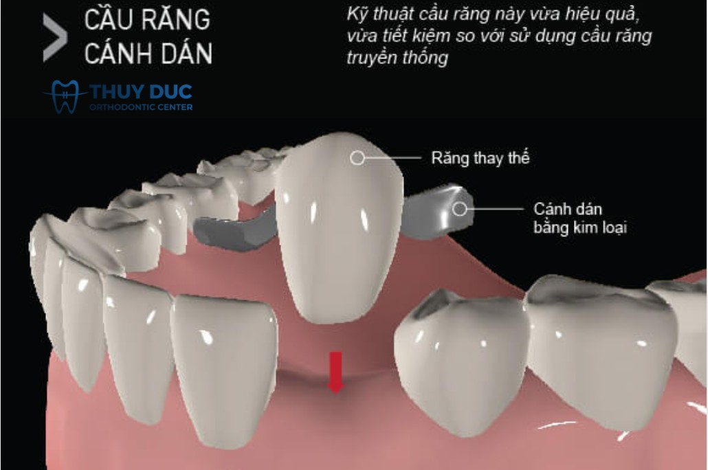 Cầu răng cánh dán 1