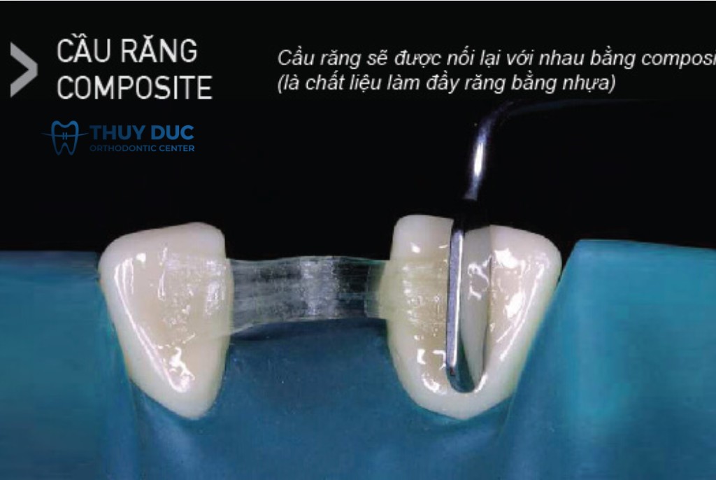 Cầu răng Composite 1