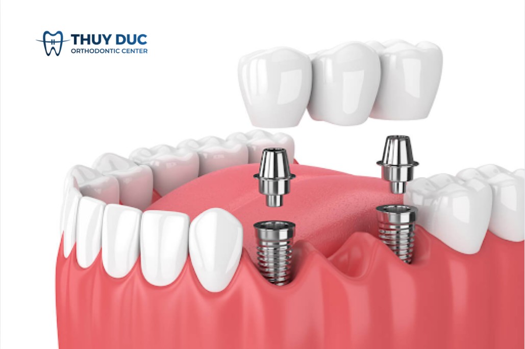 Có nên trồng răng implant hay không? 1