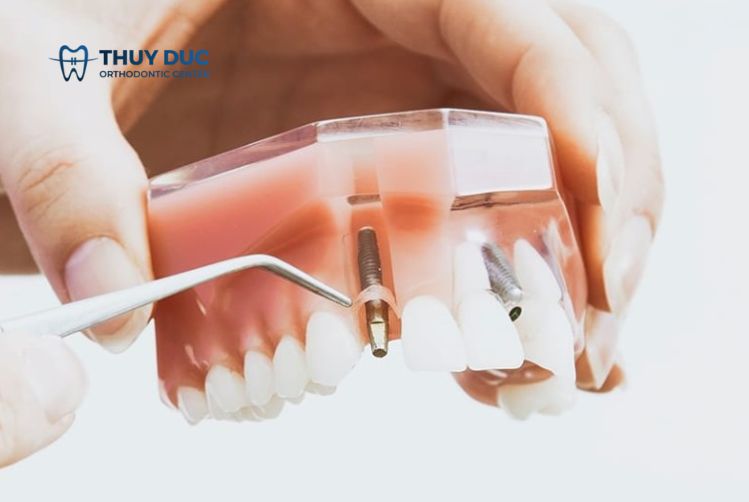 Cấy ghép implant là gì? 1