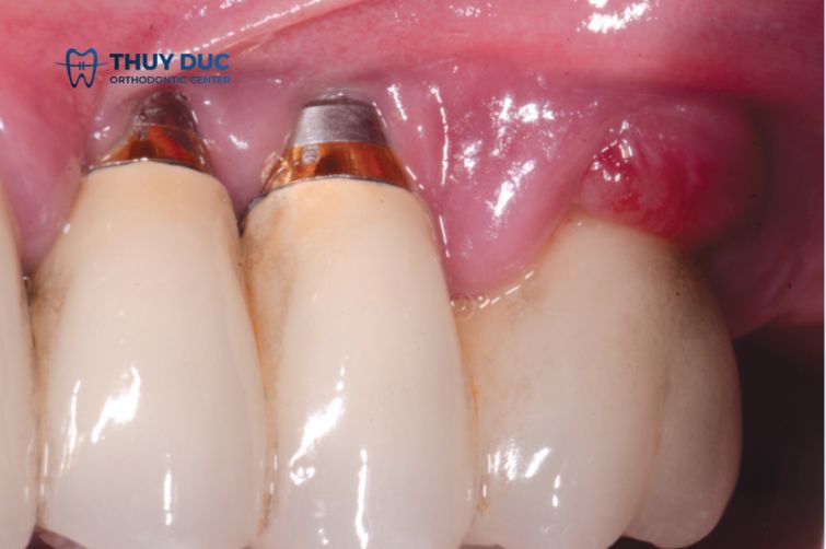 Implant bị đào thải như thế nào? 1