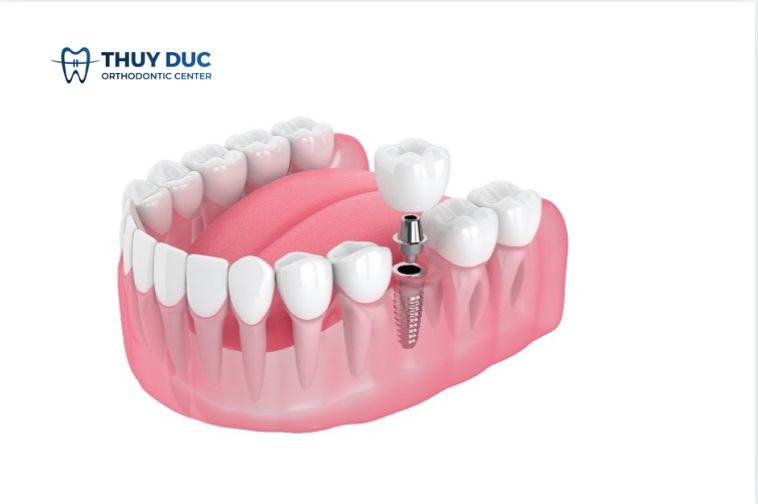 3. Bảo tồn răng thật 1