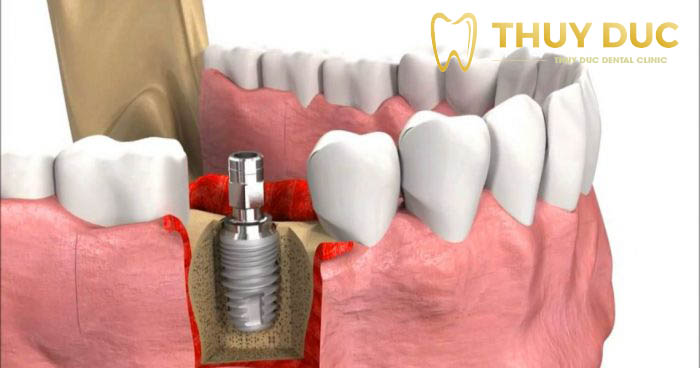 Trồng răng số 6 bằng cách cấy ghép trụ răng implant 1