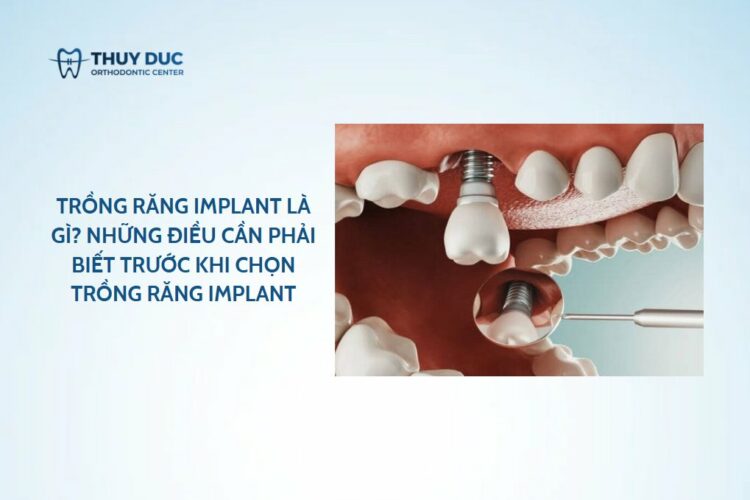 Trồng răng implant là gì? Những điều cần phải biết trước khi chọn trồng răng implant