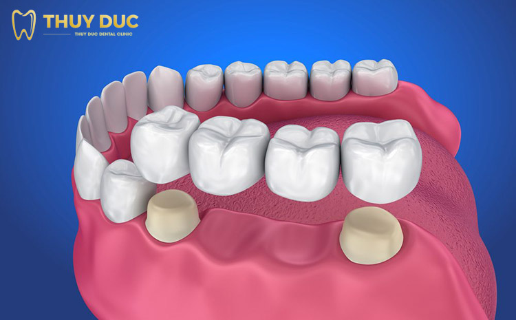 Trồng răng số 6 bằng cầu răng sứ 1