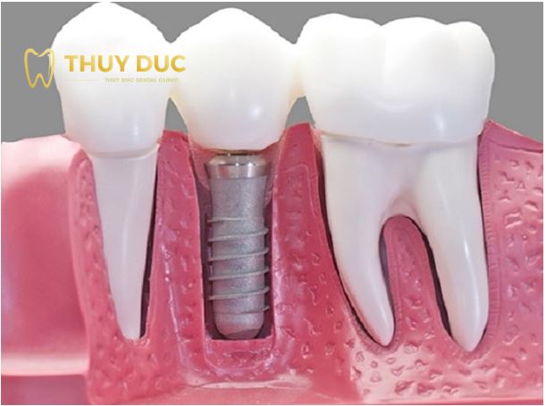 Trồng răng implant - Phương pháp trồng răng số 7 cho hiệu quả tối ưu nhất 1