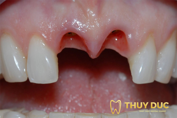 1. Mất răng lâu năm gây ra hậu quả gì? 1