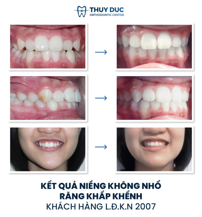 Kết quả niềng răng không cần nhổ răng cho trẻ 2