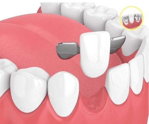 Cầu răng sứ có cánh dán 1 Cầu răng sứ có cánh dán 1