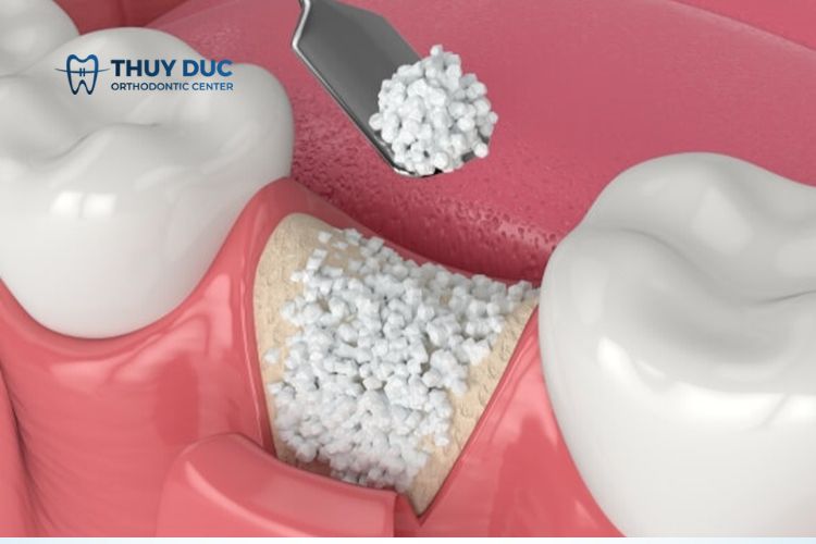 Phẫu thuật ghép xương để cấy ghép implant có nguy hiểm không? 1