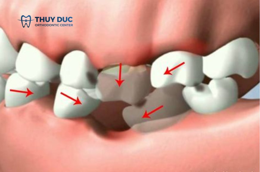 Hậu quả của mất răng số 6 và 7 1