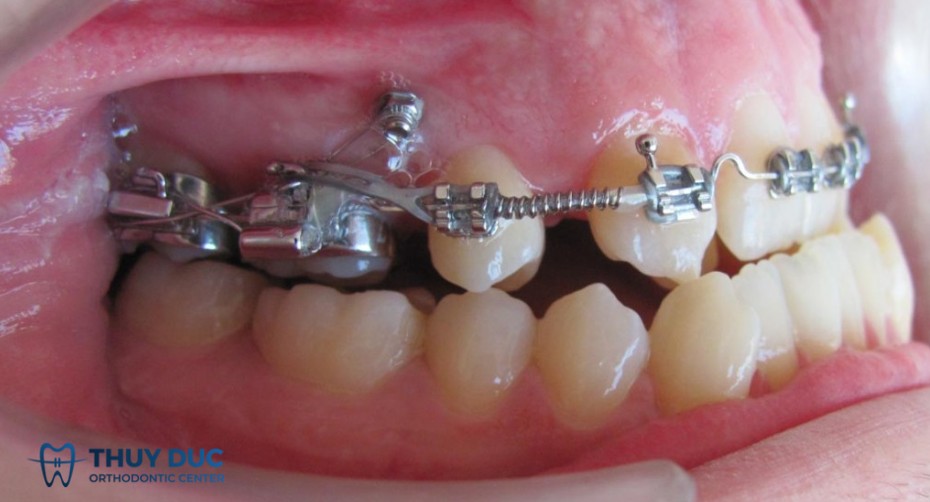 Cắm vít khi niềng răng là gì? 1