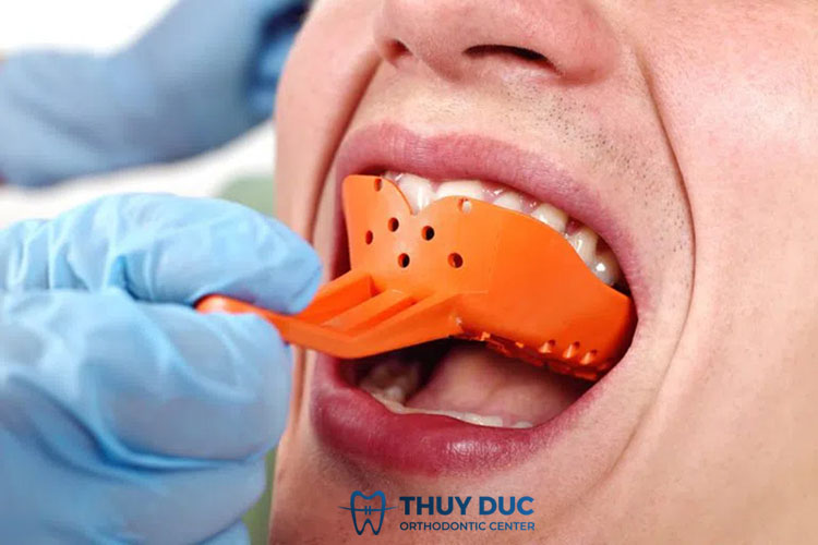 Bước 2: Lấy dấu hàm để làm răng giả 1